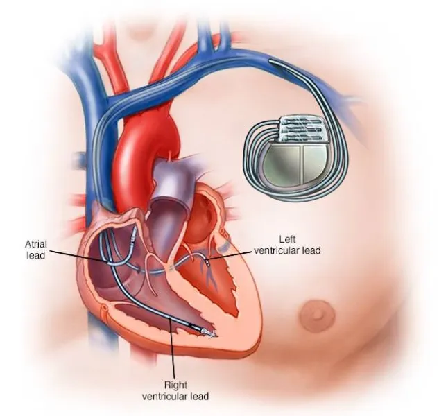 Pacemaker Guidance in Pashan