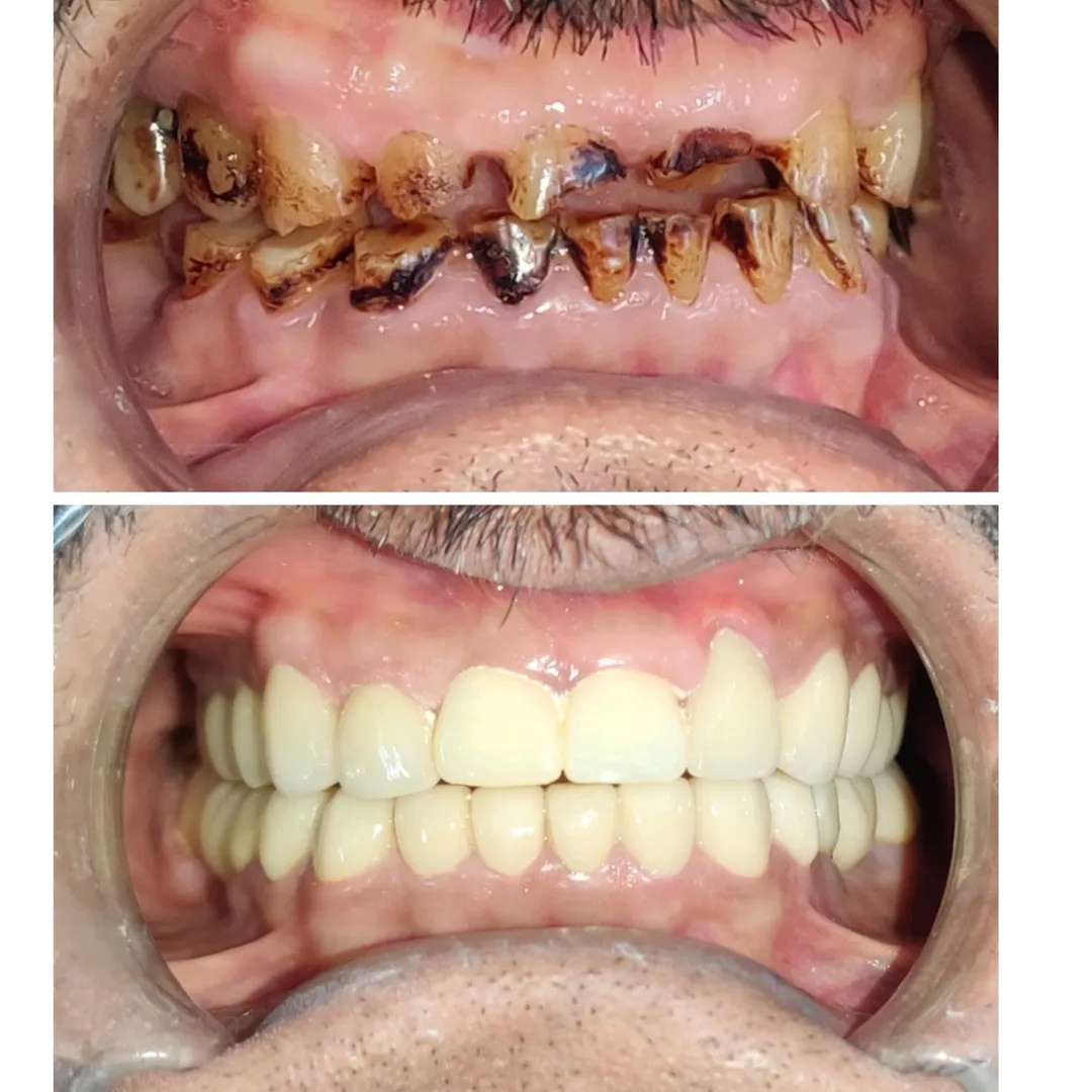 Full Mouth Rehabilitation