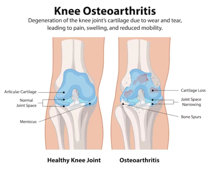 Osteoarthritis Doctor in Nagarbhavi, Bangalore