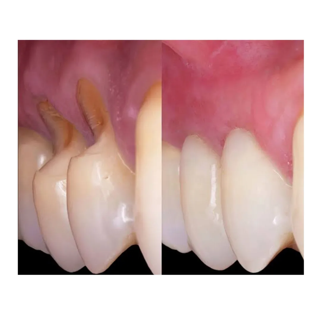 Management of Non-Carious Cervical Lesions