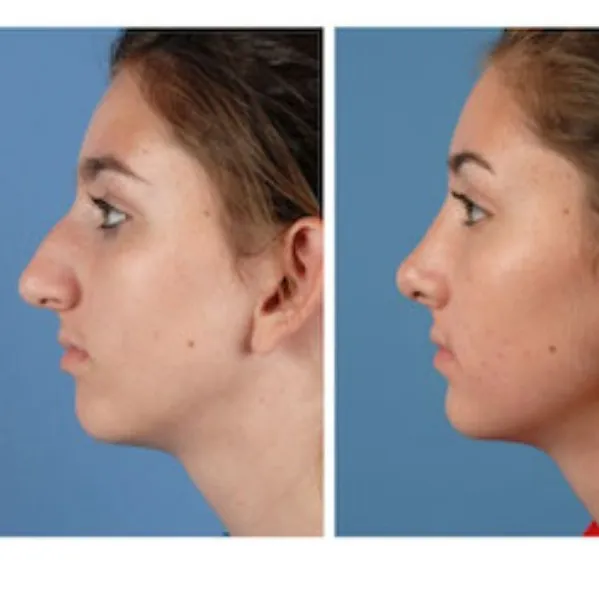 Nose Reshaping in Delhi