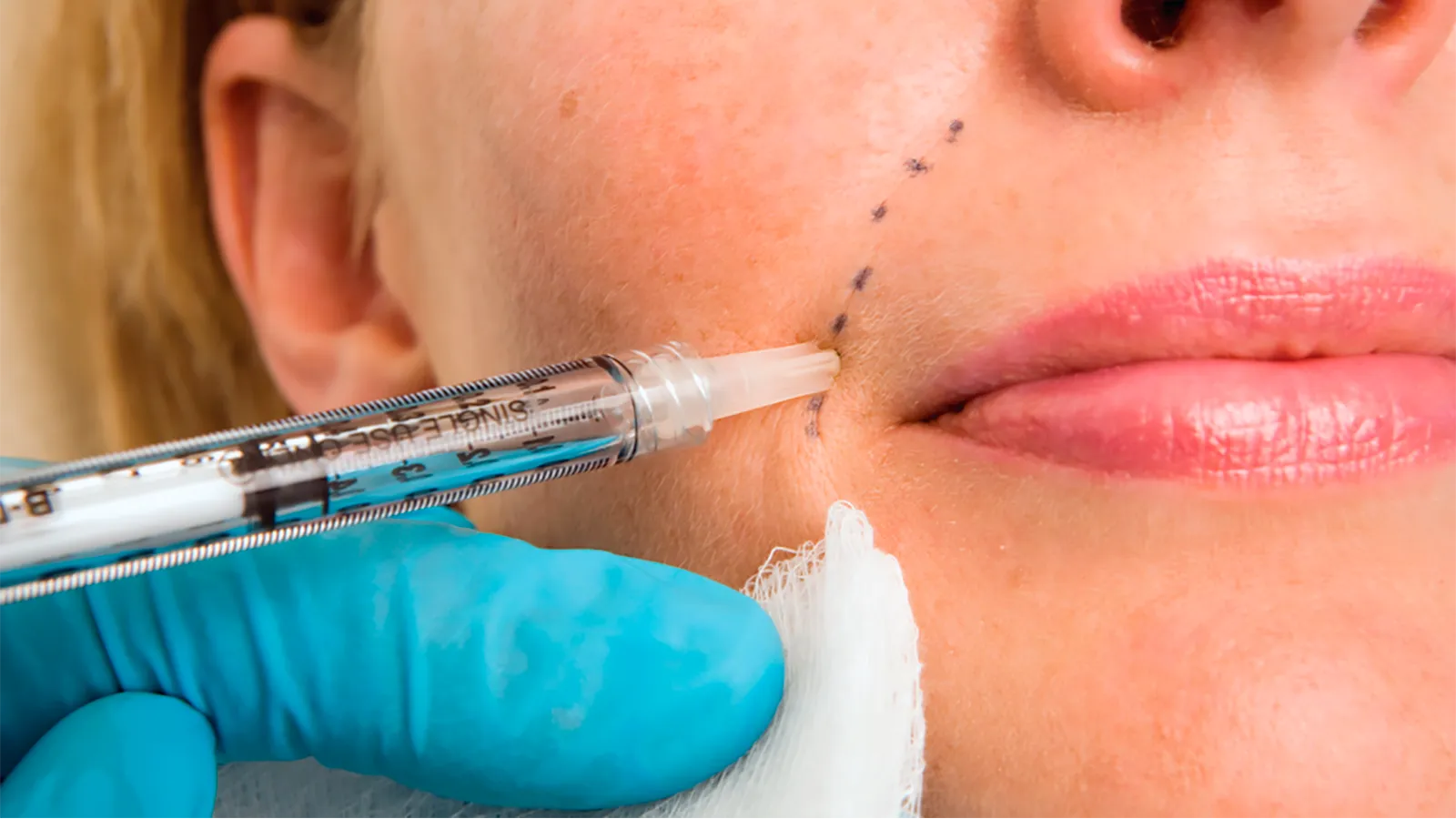 Dermal Fillers in Delhi