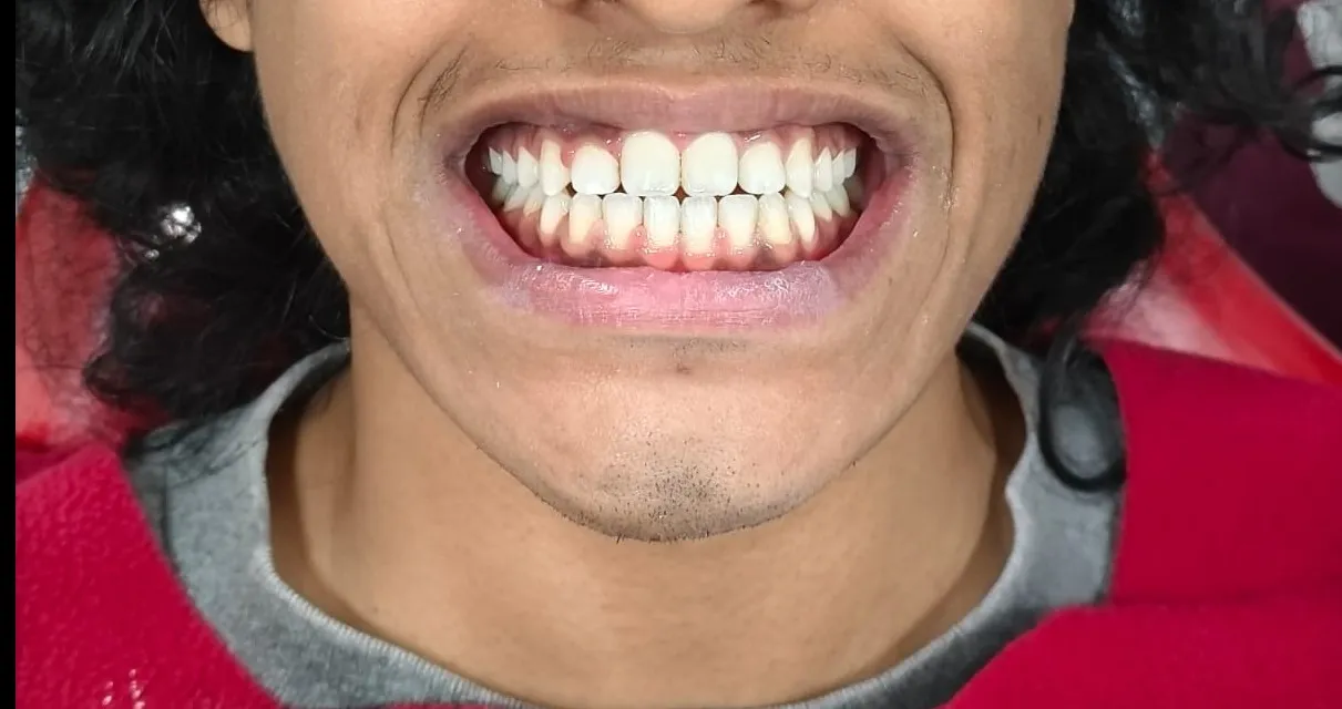 Teeth Whitening After Braces – When Is the Right Time?