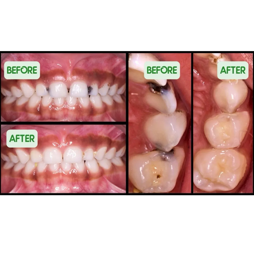 Importance of Milk Teeth & Early Dental Care