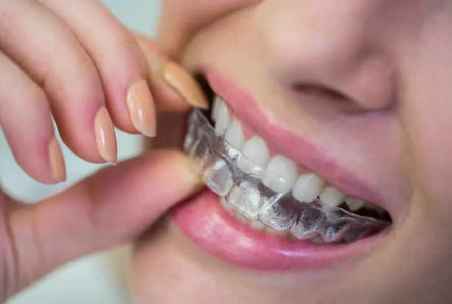 Clear Aligners Clinic in Dwarka – A Modern Path to a Confident Smile