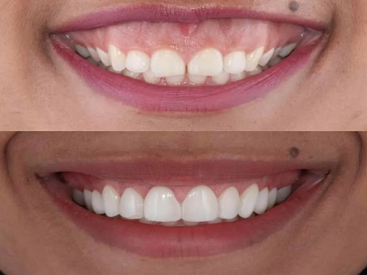 Smile correction Treatment In Vashi