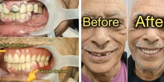 Ivoclar full dentures in Bangalore