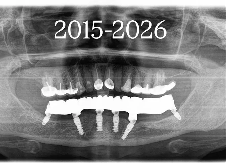 How Long Do Dental Implants Really Last?