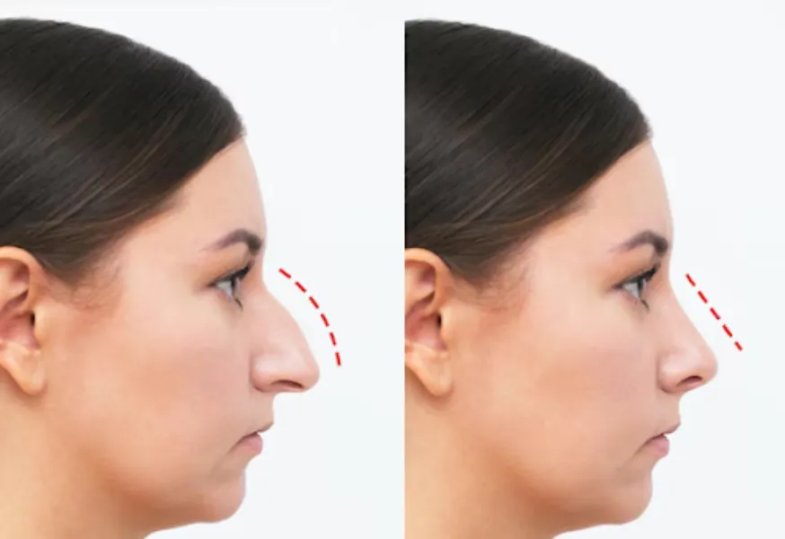Rhinoplasty Surgery in Pune – Sculpting a New You