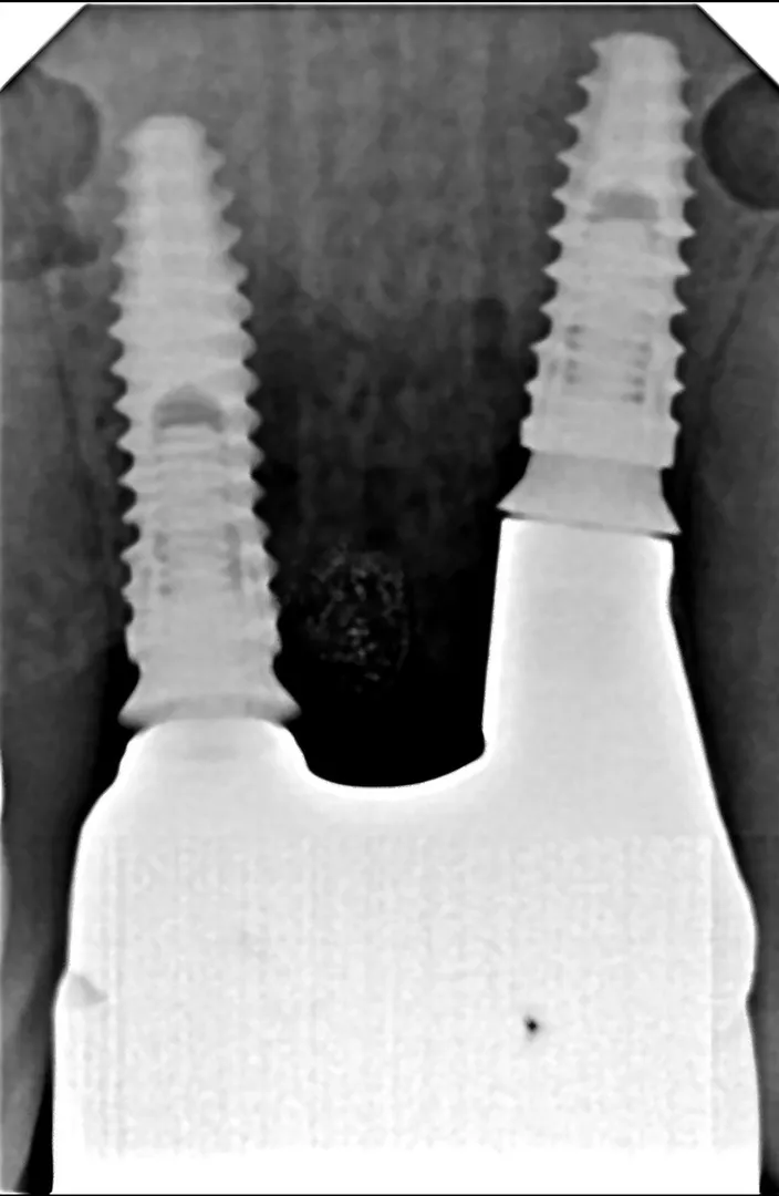 Are Dental Implants Worth It in the Long Run?