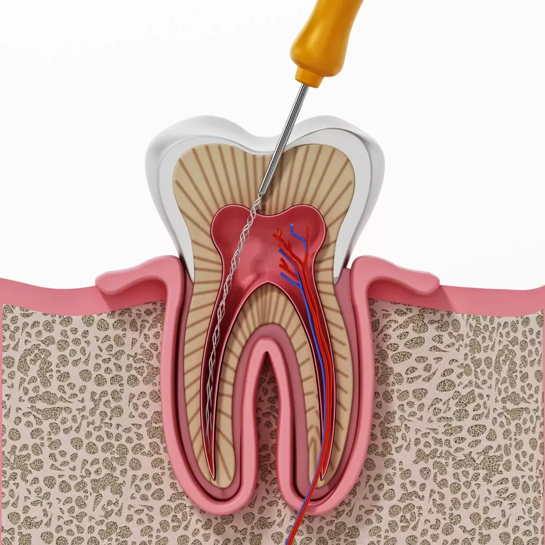 Best Root canal treatment in Shukrawar Peth