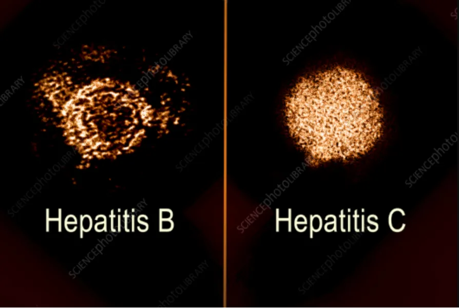 Hepatitis B Specialist in Mumbai for Long Term Monitoring
