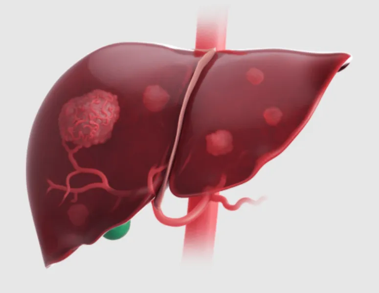 Liver Cancer Specialist Care in Mumbai for Early Detection