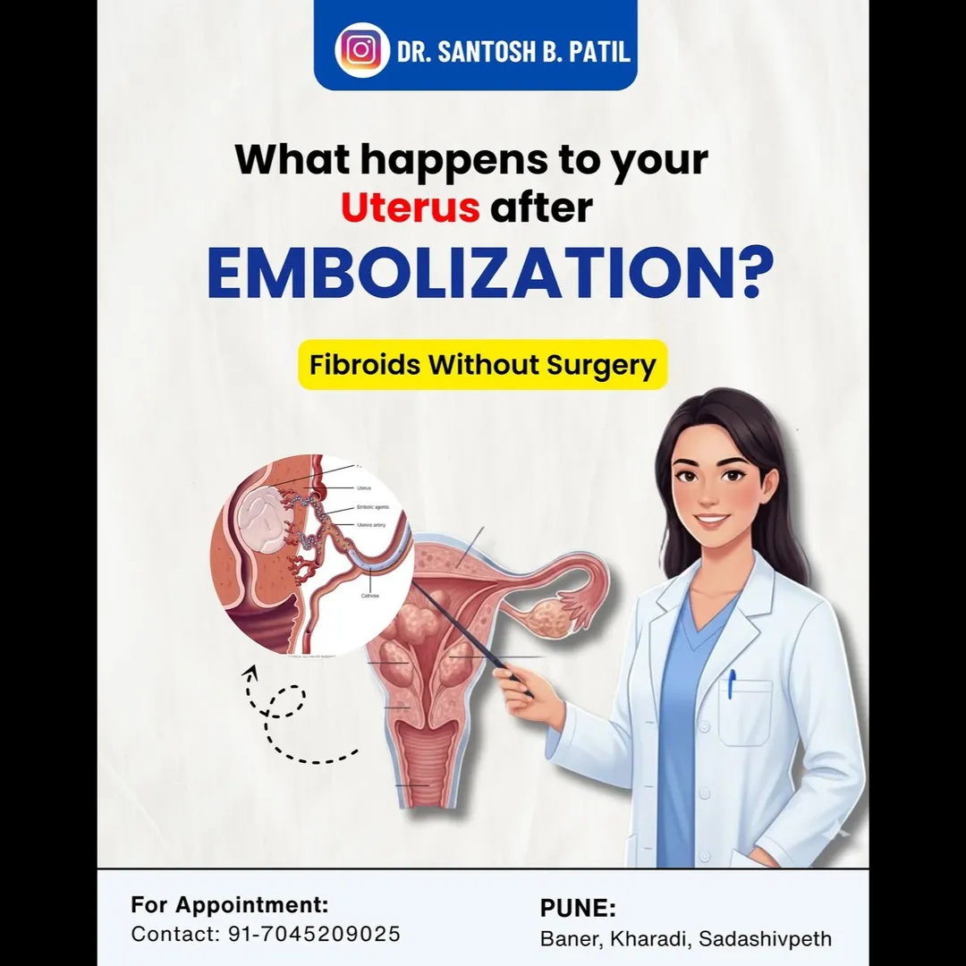 Best Doctor for Uterine Fibroid Embolization Treatment in Pune - Dr Santosh B Patil !