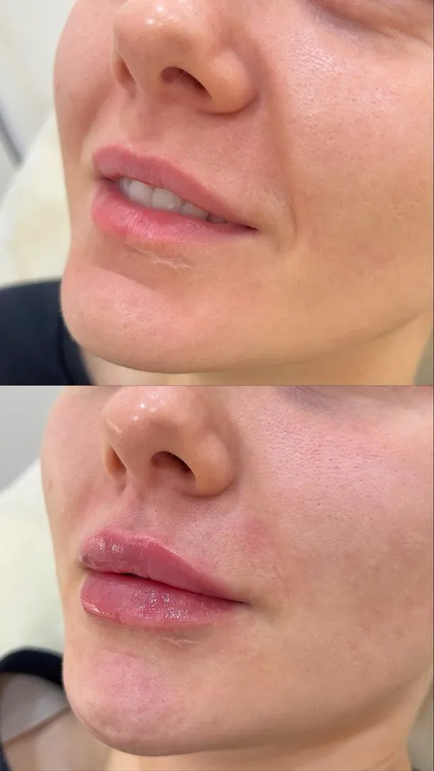 best lip filler doctor in nashik
affordable lip filler in nashik
best dermatologist in nashik