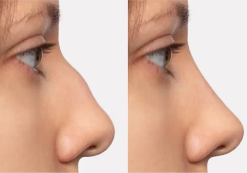 Nose Job Surgeon in Pune – Achieving Natural Results with Expertise