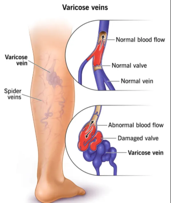 Varicose Veins Treatment in pimplLe nilakh