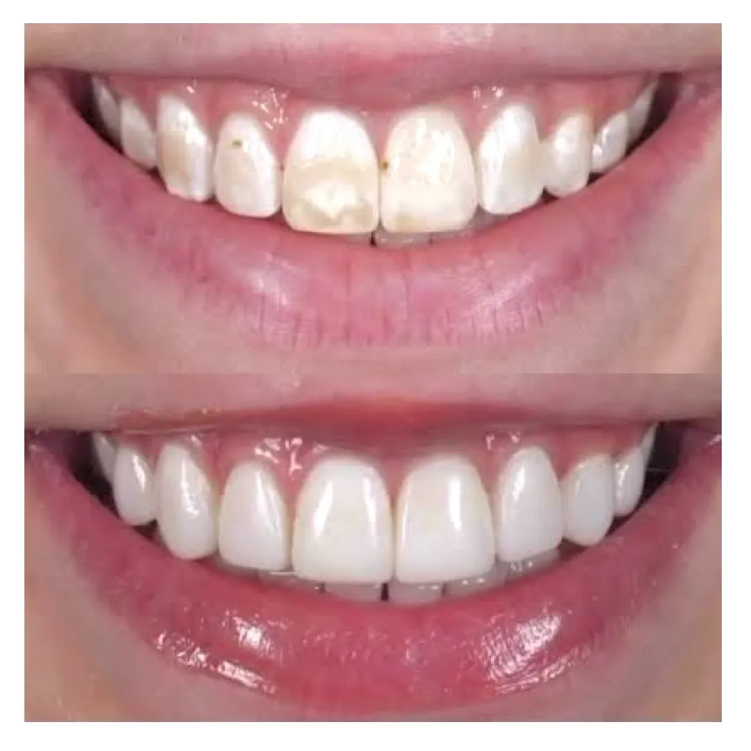 Fluorosis Management with Dental Laminates