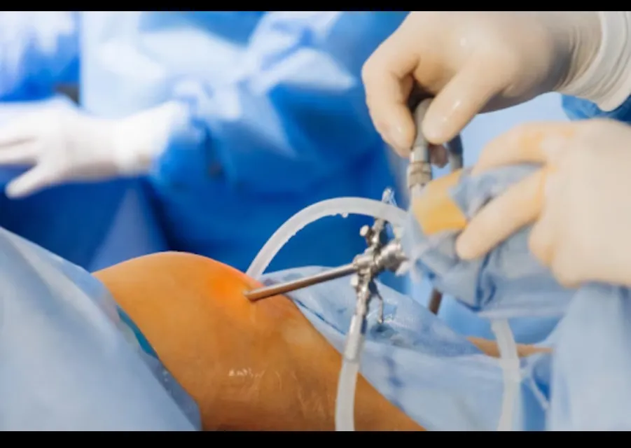 Meniscal Transplant in Bangalore – Preserving Knee Function for the Long Term
