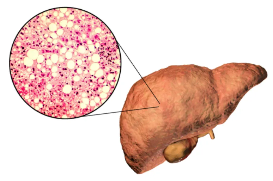 Hepatic Encephalopathy Test in Mumbai for Cognitive Changes