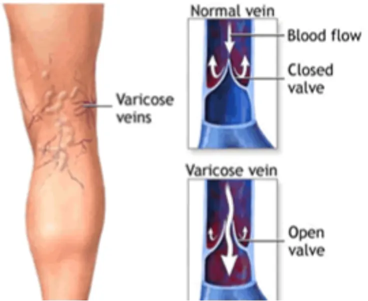 Laparoscopic Varicose Vein Ligation Surgery in Thane | Smooth Blood Flow with Modern Surgical Care