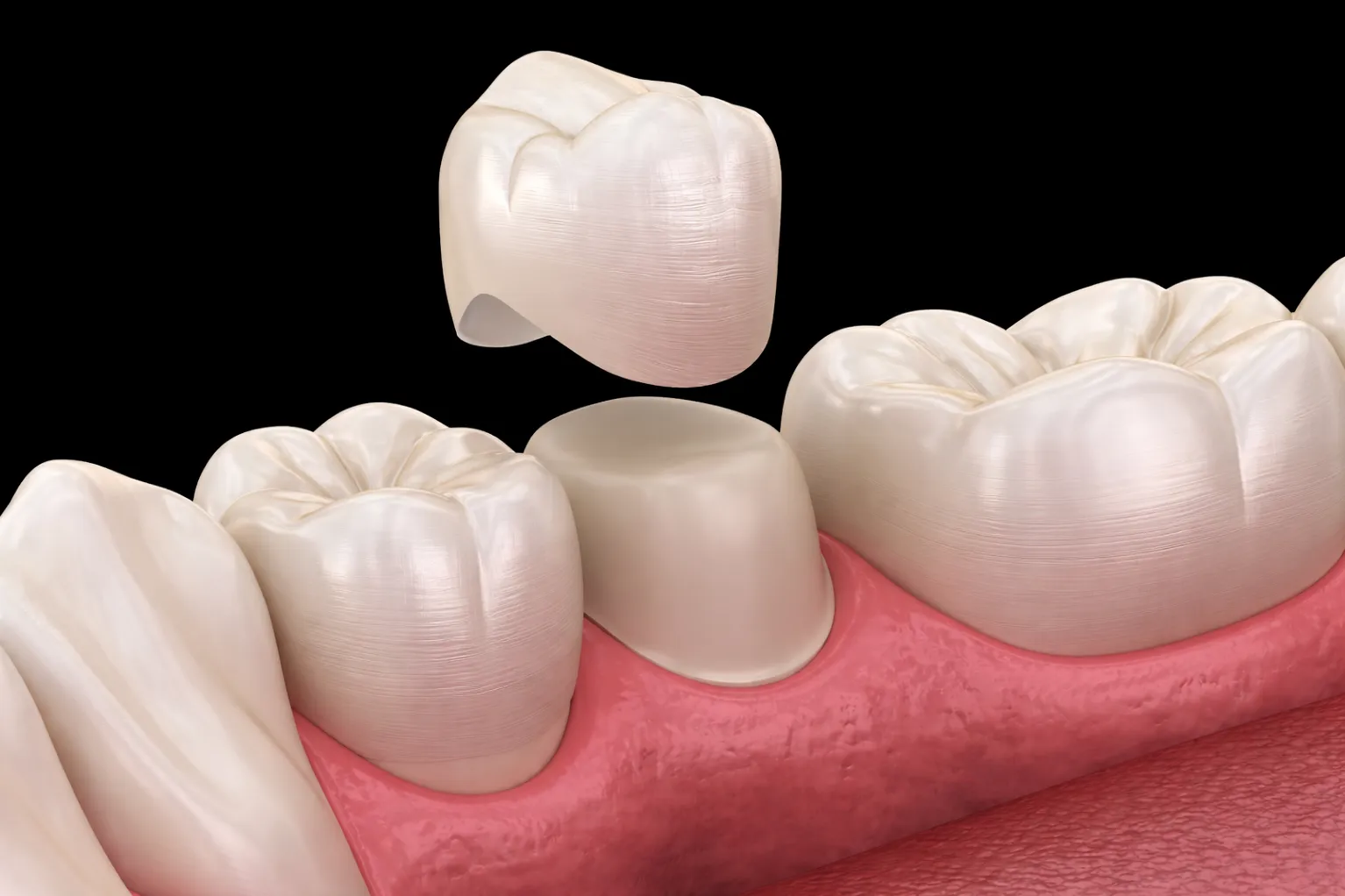 Dental Crowns in Sarjapur Road | Strong Tooth Protection Solutions