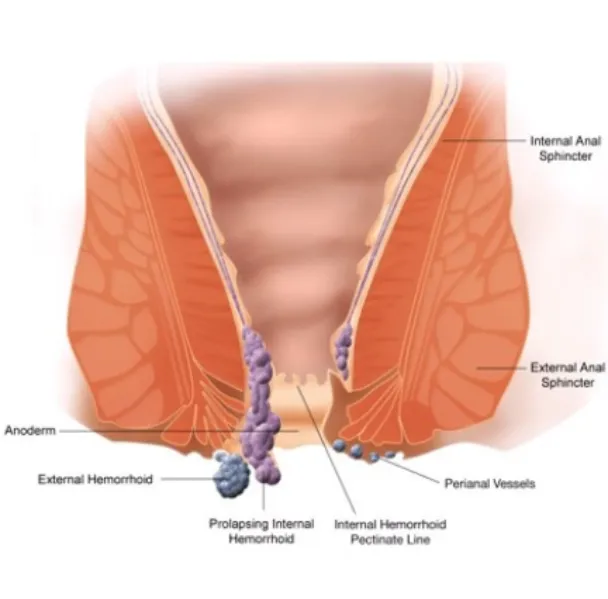 Piles Treatment in Thane | Comfortable and Lasting Relief from Rectal Pain