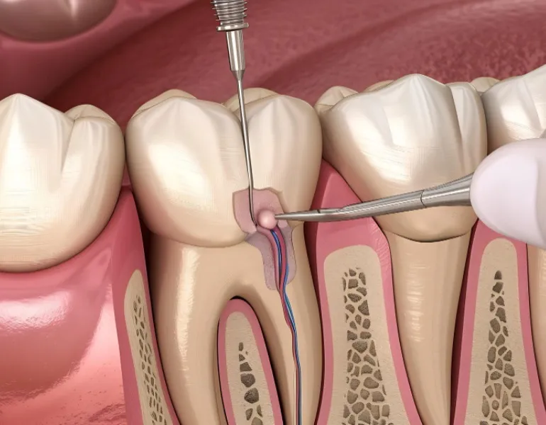 Painless Root Canal Treatment in Sarjapur Road | Comfort Focused Care