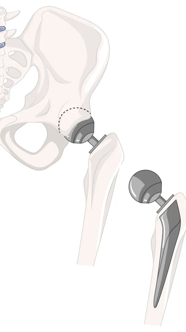 Hip Replacement Surgeon in Pune β Supporting a Pain-Free, Balanced Life