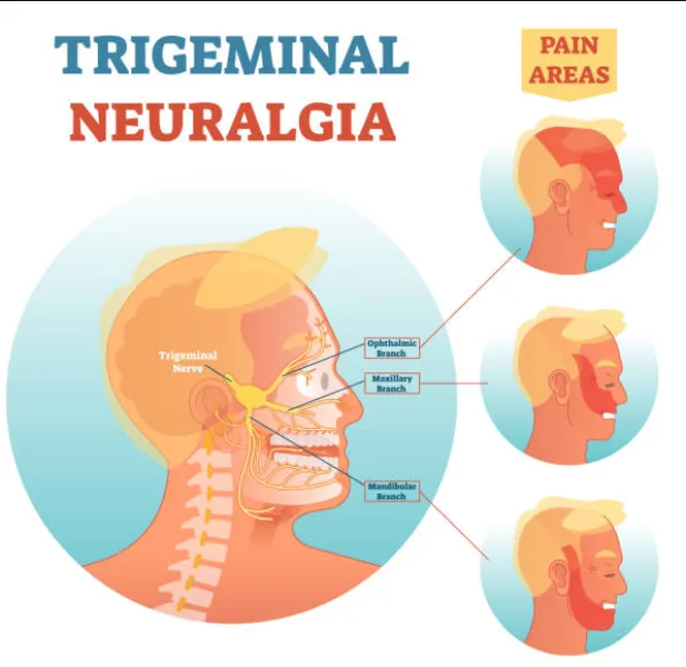 Trigeminal Neuralgia Treatment in Nagpur at Somalwar Neuro Clinic