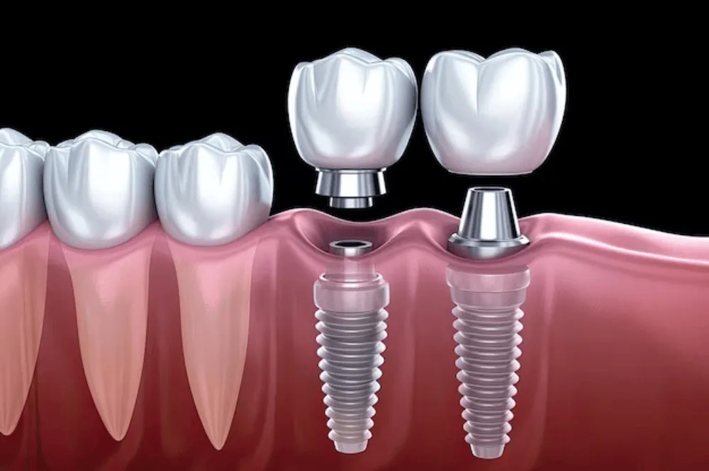 Best Dentist For Dental Implants in Dwarka