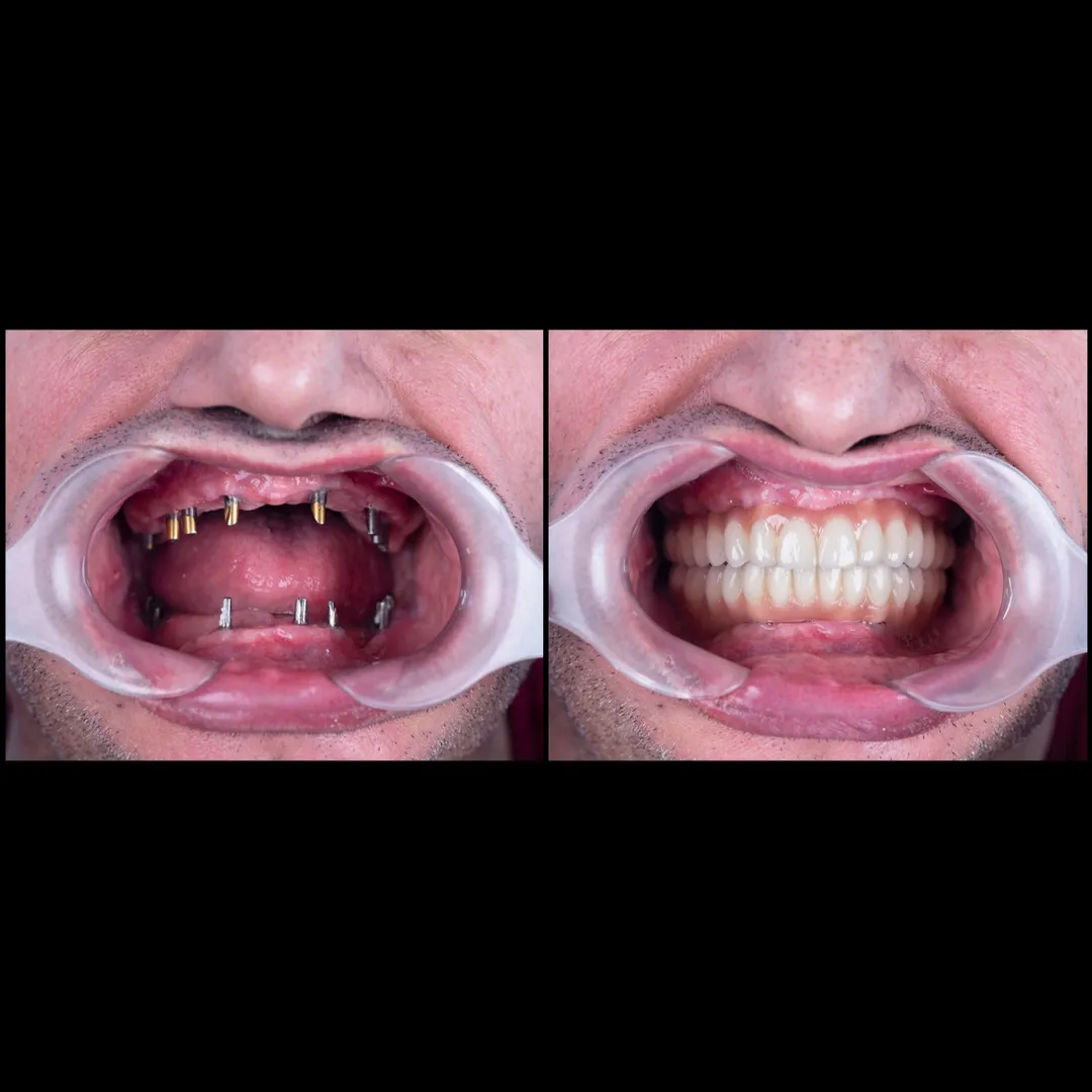 Best Dental Clinic for Immediate Implants in Dwarka