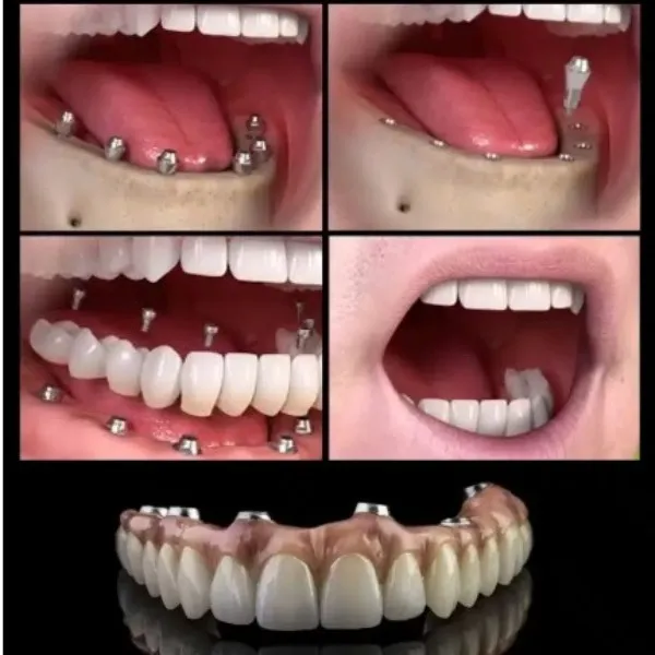 Best Dentist for Immediate Implants in Dwarka