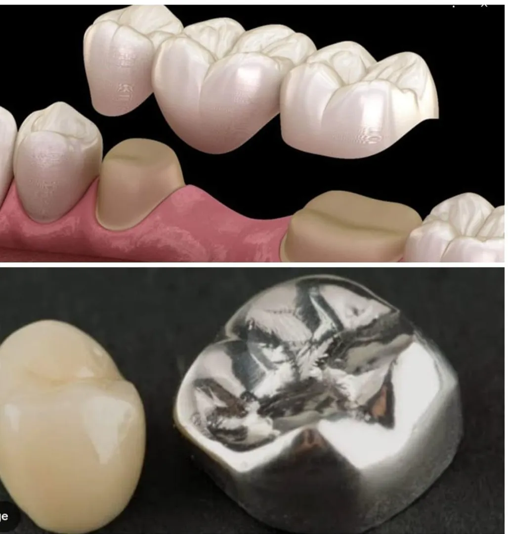 Zirconia Crowns vs Metal Crowns – Which Should You Choose?