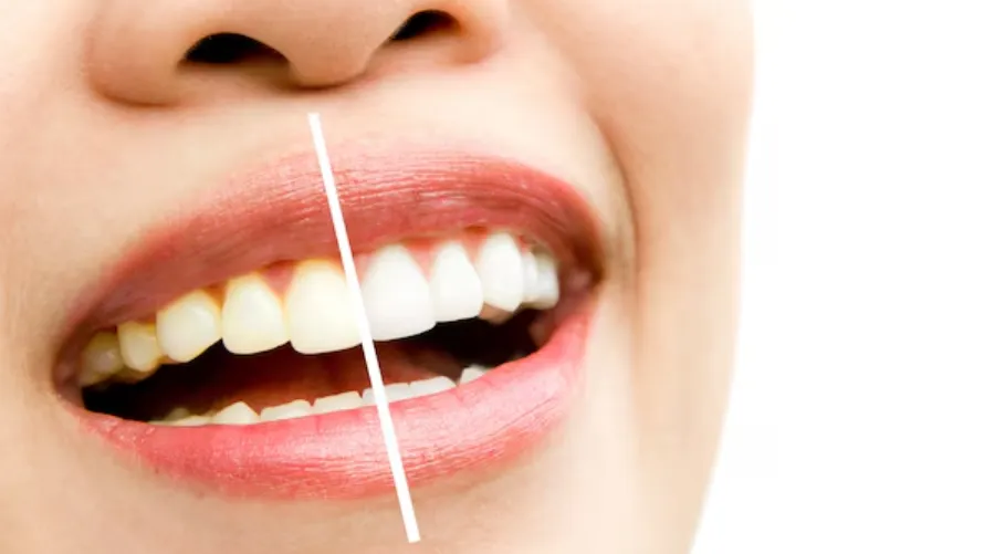 Affordable Teeth Whitening in Dwarka – Brightening Smiles the Right Way