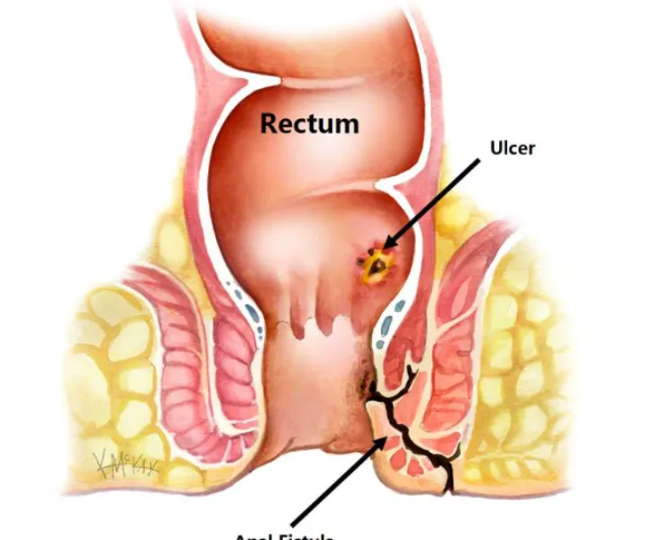 Fistula Surgery in Hinjewadi