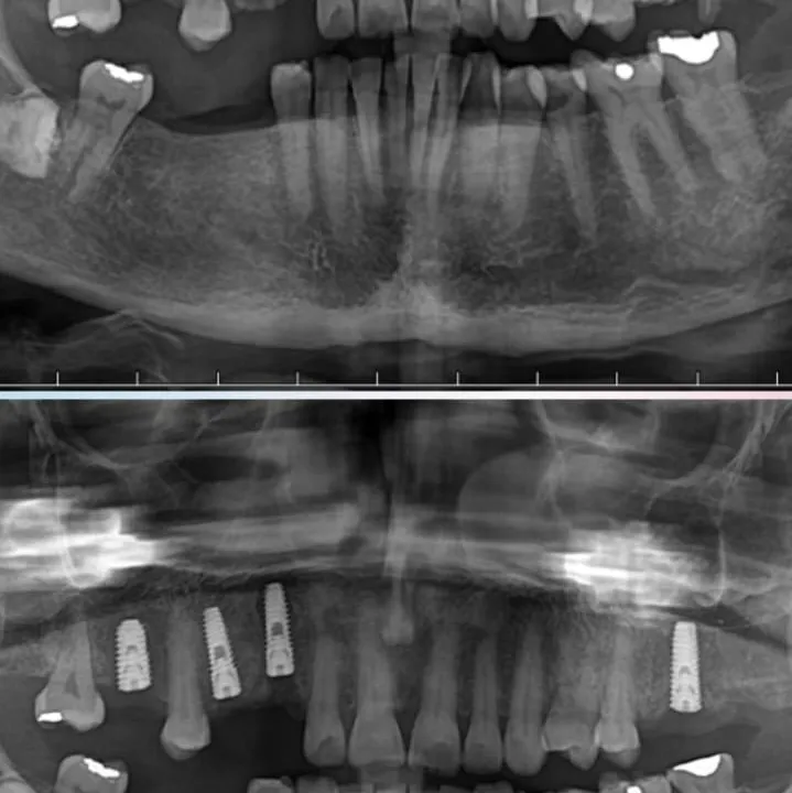 Dental Implants in Bengaluru – Precision. Planning. Perfection.