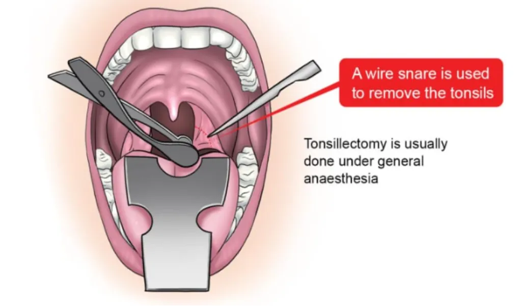 Laser Tonsil Surgery in Nashik – A Modern Approach to Tonsil Problems
