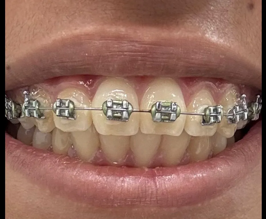 What Is the Right Age to Start Braces?