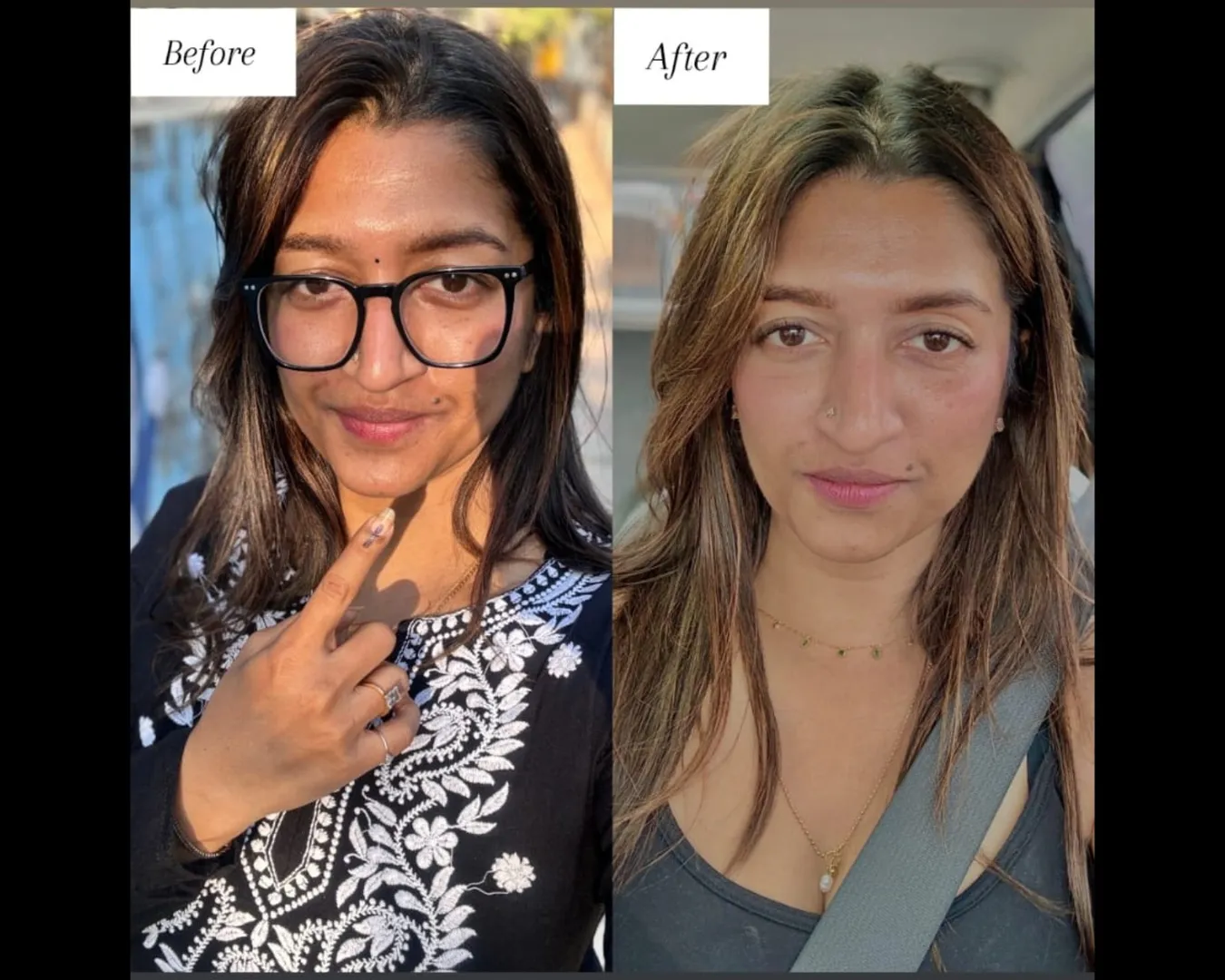 Best Microneedling in vashi