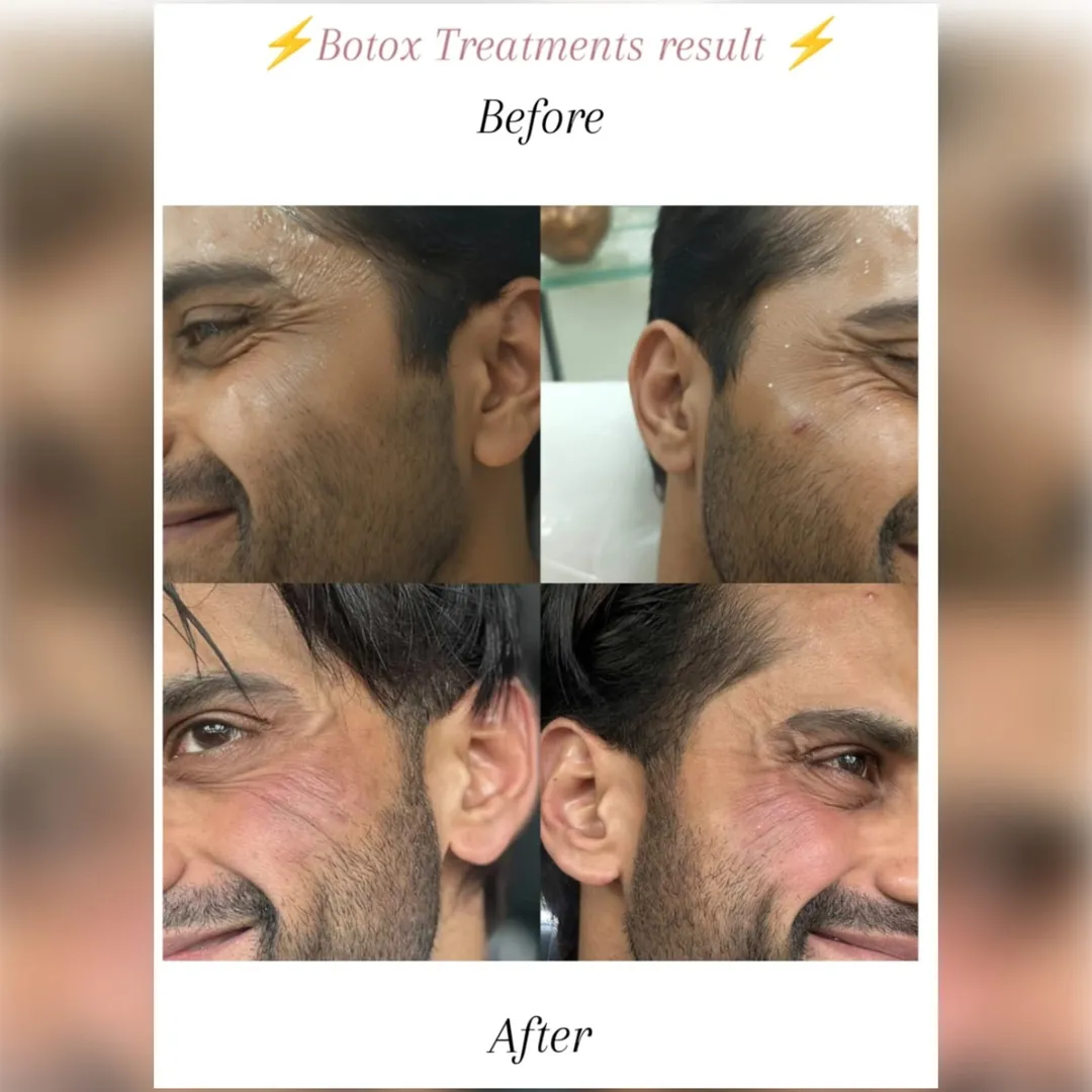 ✨ Best Botox Treatment in Vashi