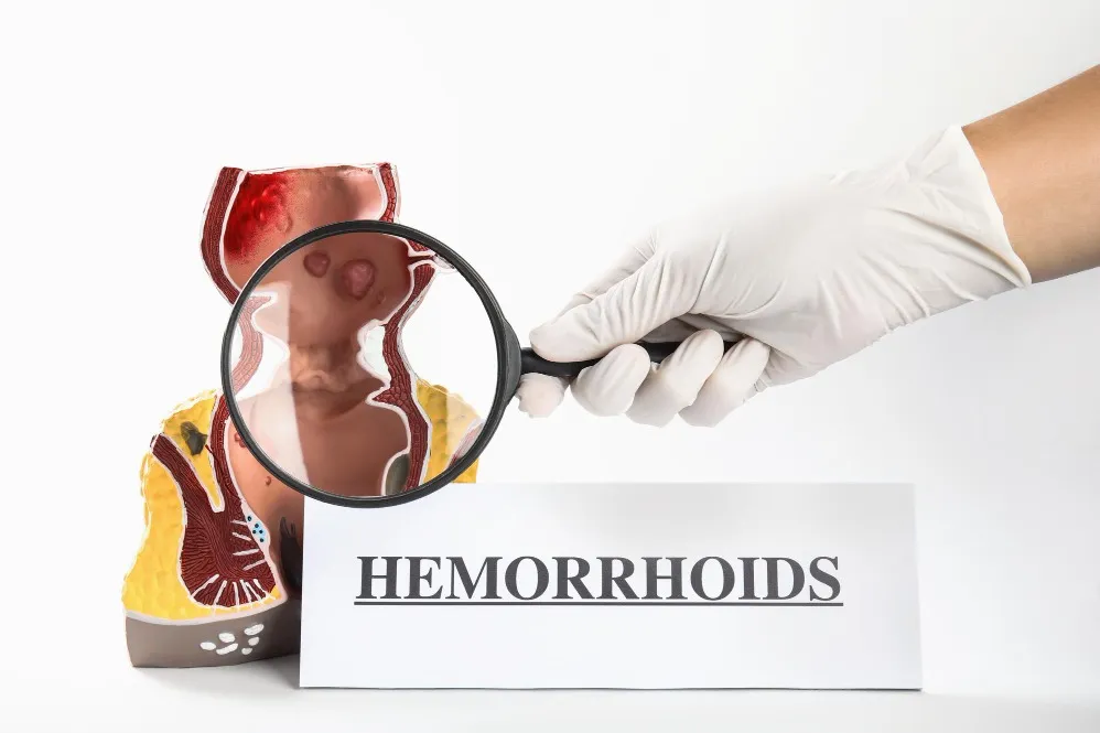 Laser Hemorrhoids Treatment in Mazgaon – Relief from Painful Hemorrhoids Without Surgery
