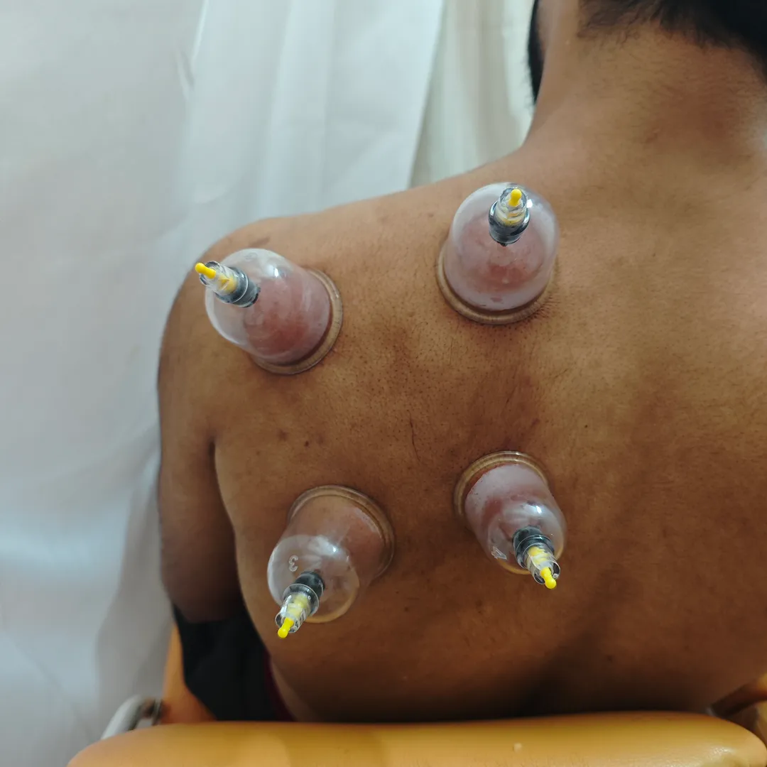 cupping therapy