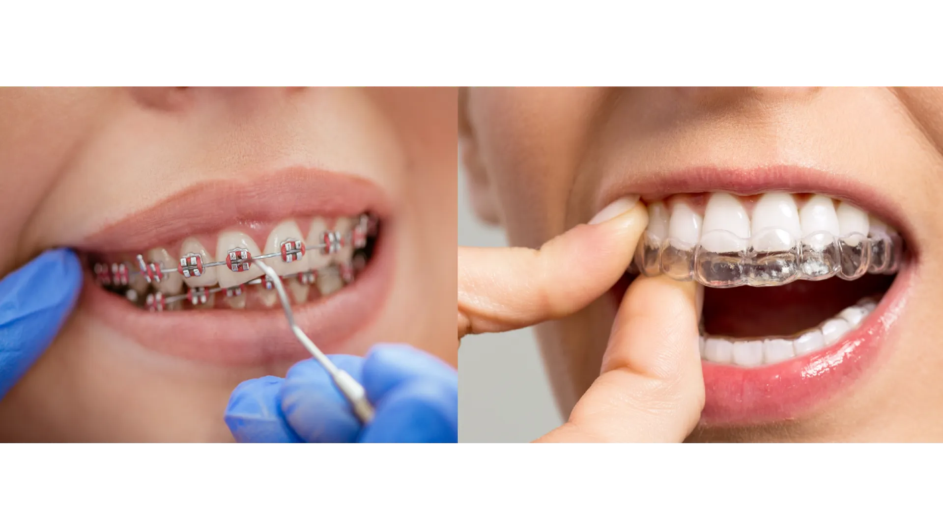 Orthodontic Treatment in Madhura Nagar – Straightening Teeth at Any Age