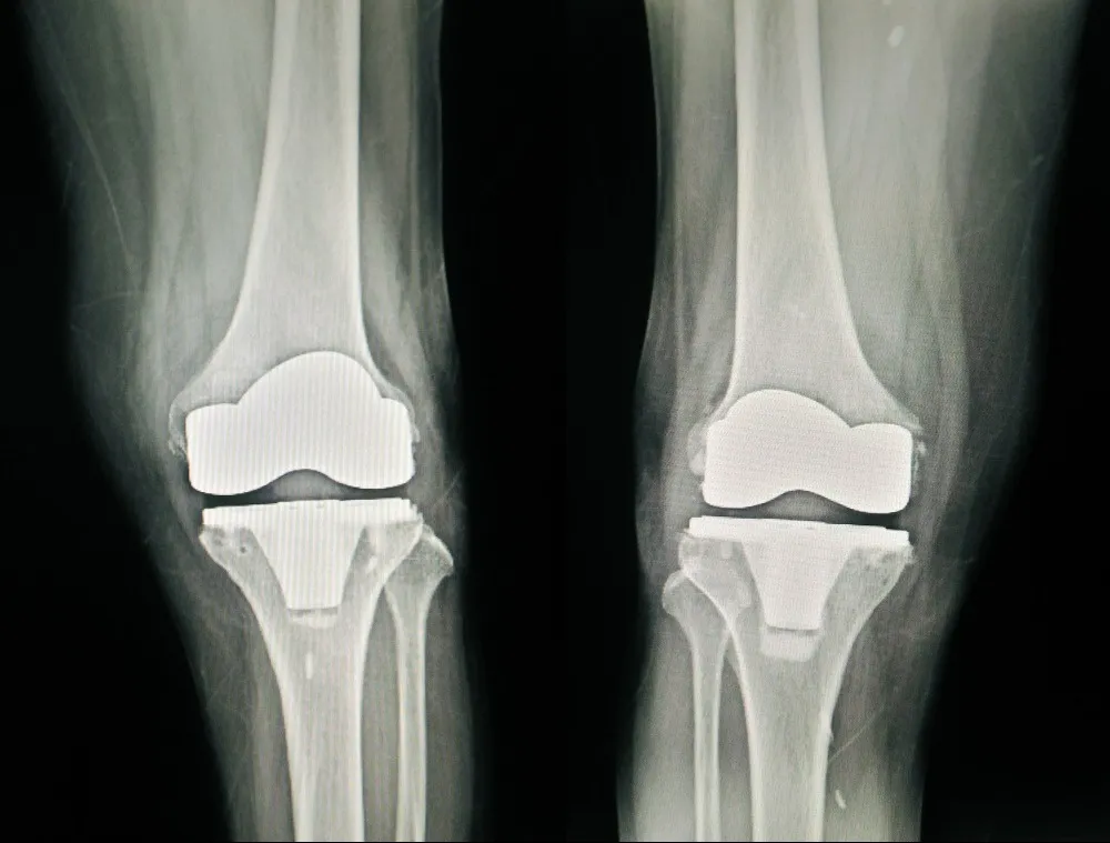 Revision Knee Replacement Surgeon in Shalimar Bagh – When Previous Surgery Needs Reassessment