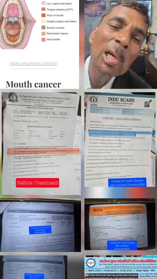 Mouth Oral Buccal Mucosa Cancer मुंह के कैंसर responded by Dr Arpit Chopra Jain Aarogya Super Specia...