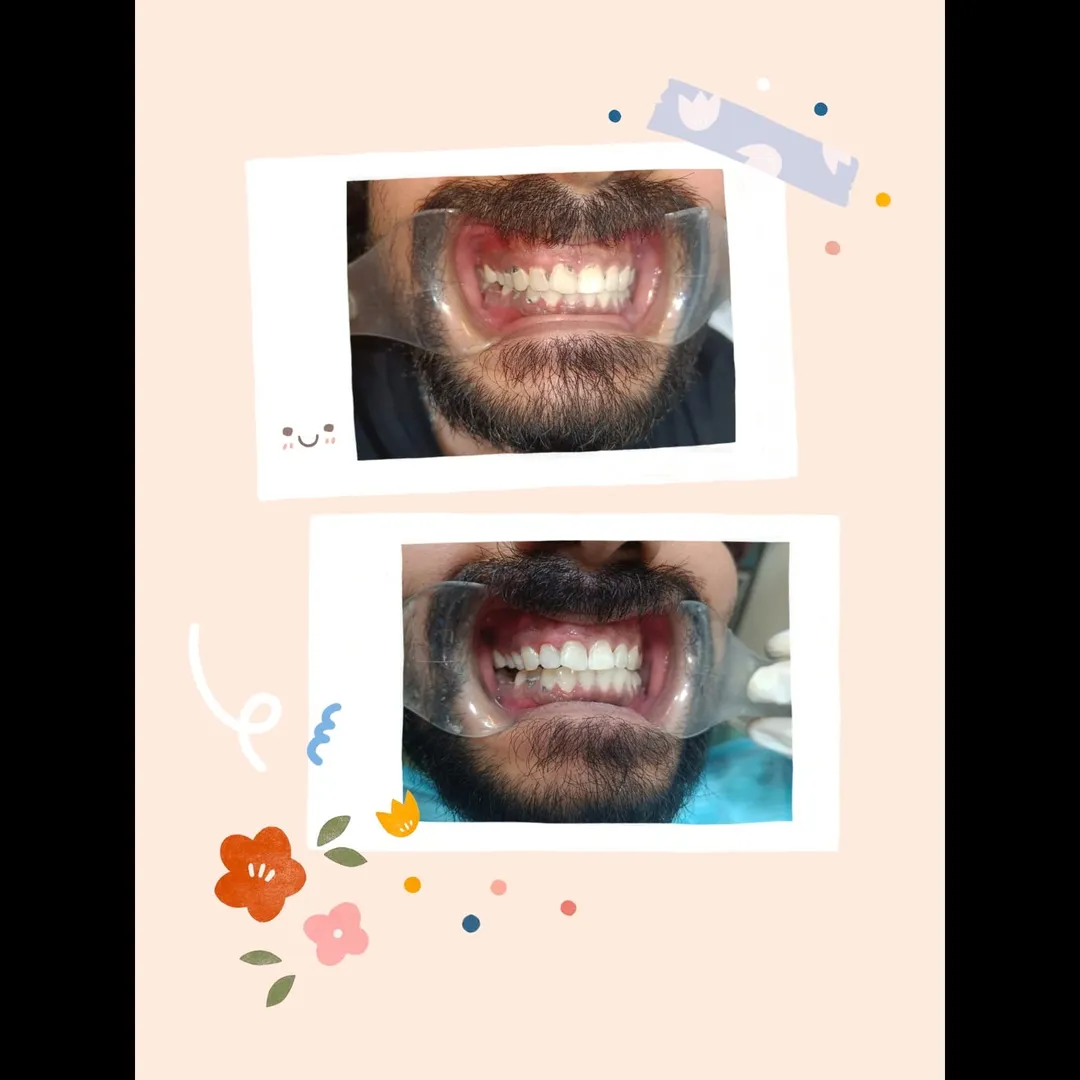 Dental Cavities Treatment in Gaur City | PD Dental Clinic