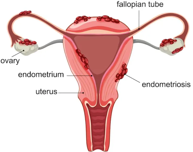 Endometriosis Doctors in Thane – Addressing Chronic Pain With Care
