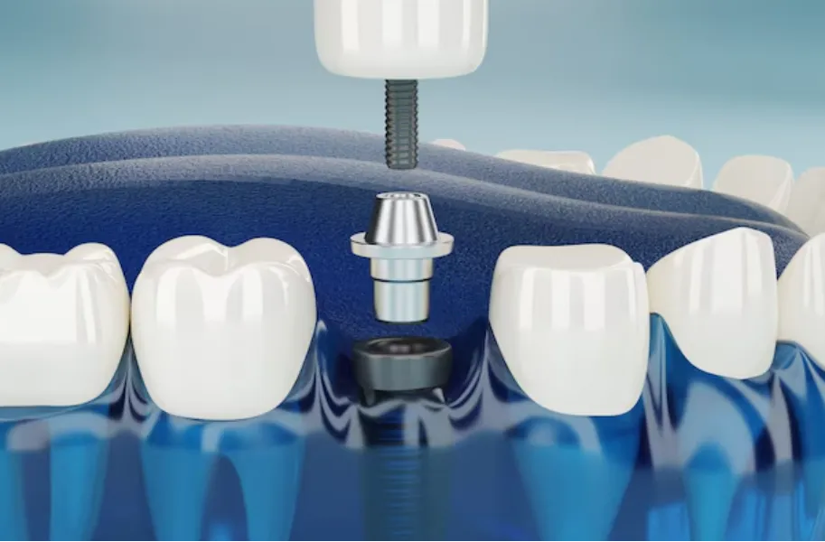 Best Affordable Dental Implants in Dwarka – A Smarter, Budget-Friendly Solution
