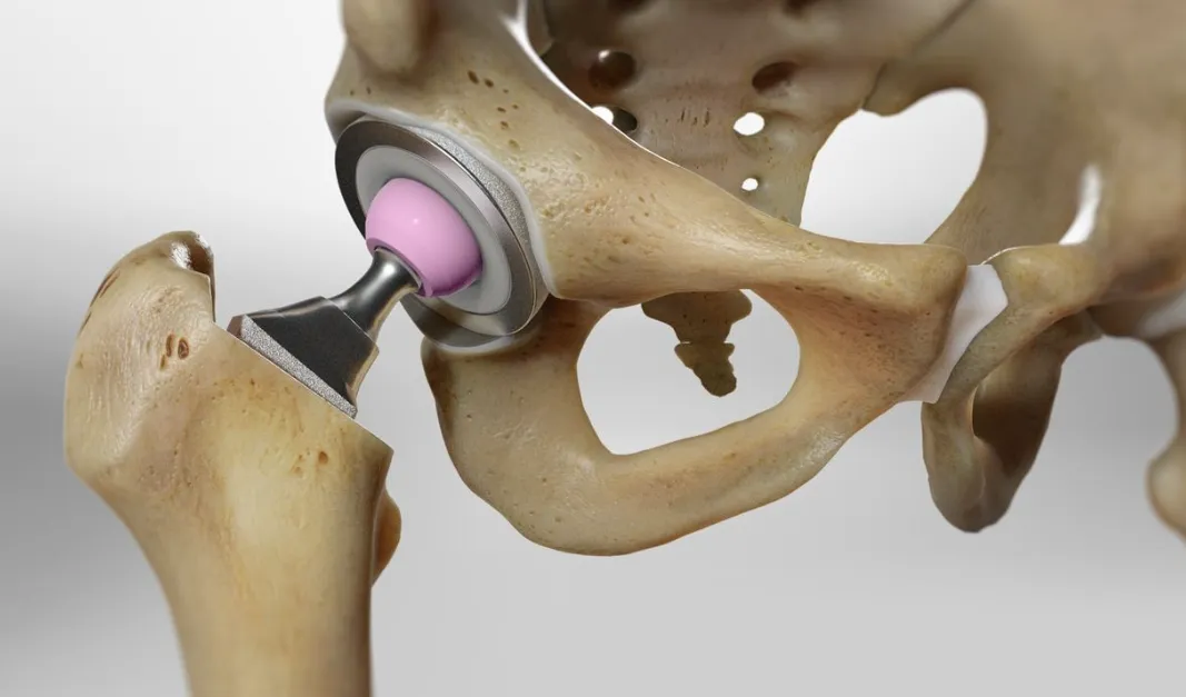 Best Hip Replacement Surgeon in Delhi Supporting Pain Free Mobility